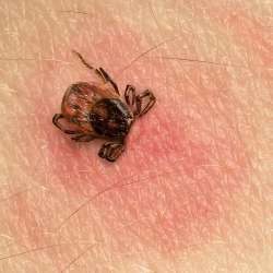 A tick with its head sticking in human skin, the skin is red from the tick bite